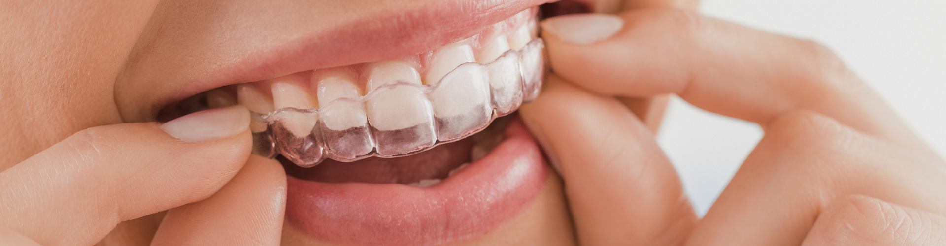 Woman placing clear aligner onto upper teeth.